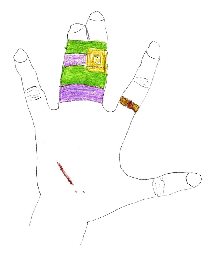 Gebroken vingers "Ik heb twee keer mijn vingers gebroken" (Tekening door Karim, 2006) 